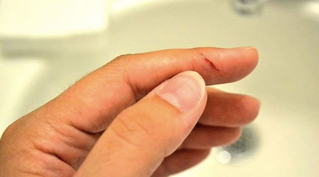 Mộng thấy người lạ bị đứt ng&oacute;n tay